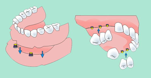 denture and bridge on implants